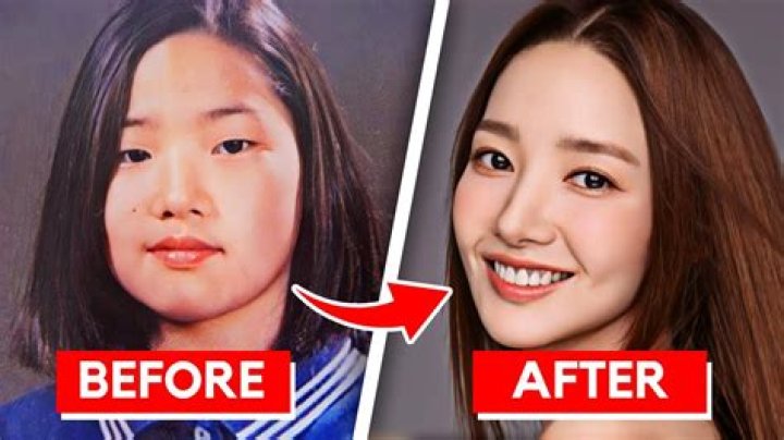 Kim Young Dae Nose Surgery: The Transformation of a Rising Star