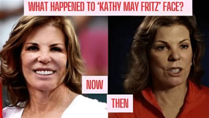 The Ultimate Guide to Kathy May Fritz's Face Surgery Journey