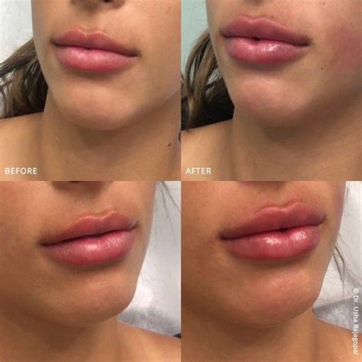 Understanding Bleach Fillers: A Comprehensive Guide